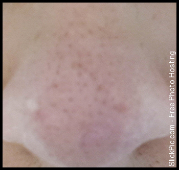 acne_nose.jpg